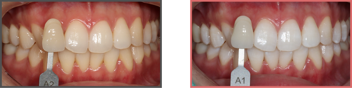치아미백 증례08