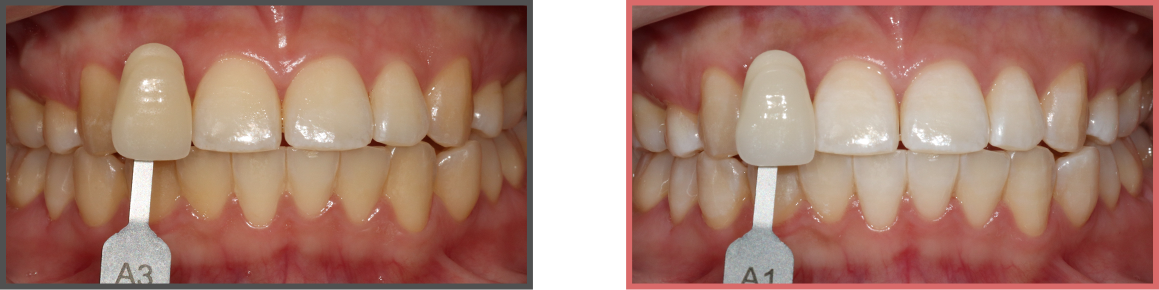 치아미백 증례09