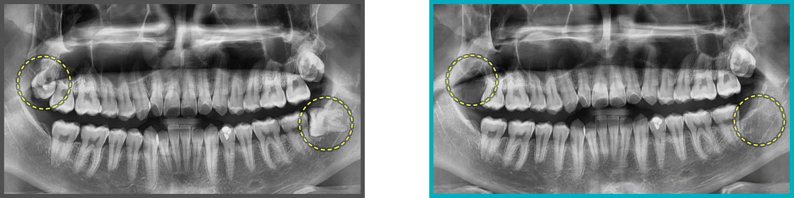 사랑니 발치 증례01