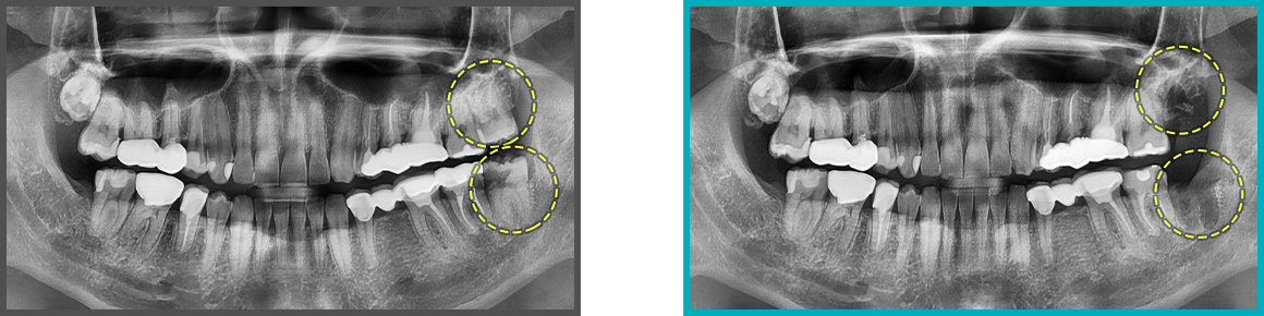 사랑니 발치 증례03