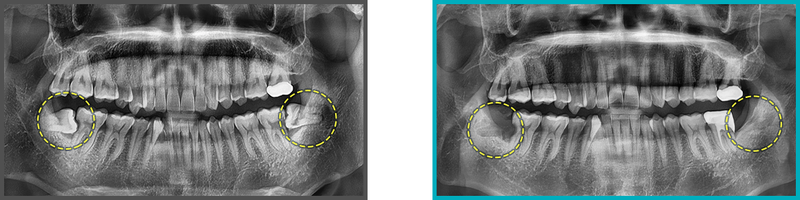 사랑니 발치 증례04