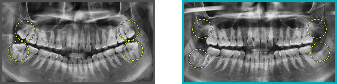 사랑니 발치 증례05