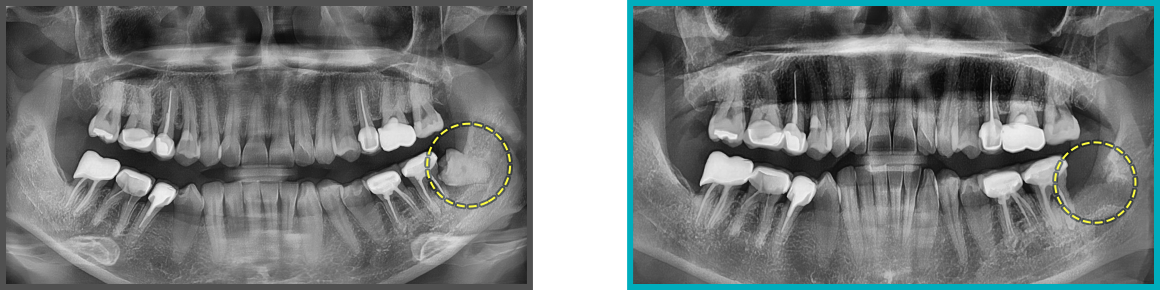 사랑니 발치 증례06