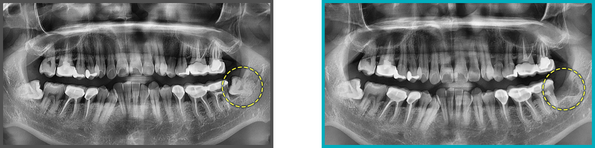 사랑니 발치 증례07