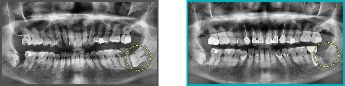 사랑니 발치 증례08
