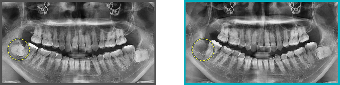 사랑니 발치 증례09