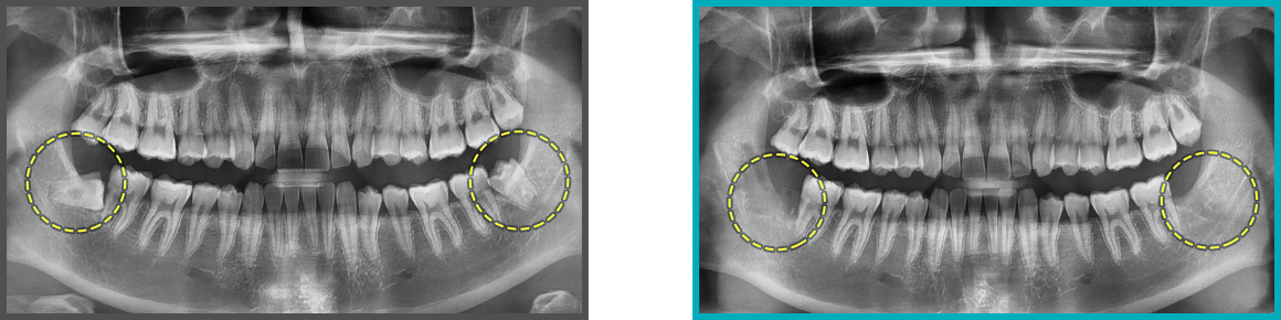 사랑니 발치 증례10