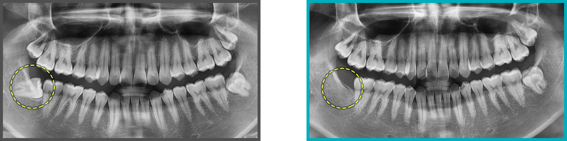 사랑니 발치 증례11