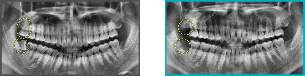 사랑니 발치 증례12