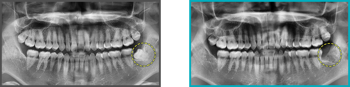 사랑니 발치 증례13