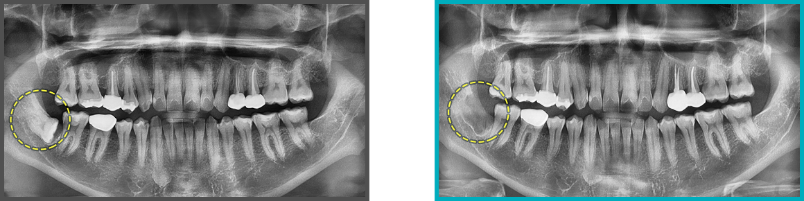 사랑니 발치 증례14