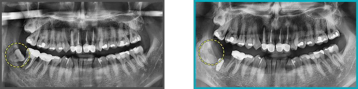 사랑니 발치 증례15