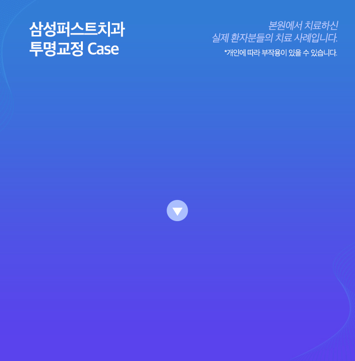 투명교정